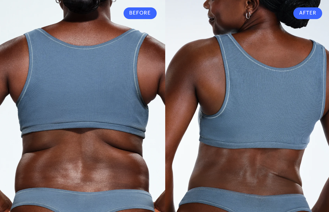 Back & Bra Fat CoolSculpting